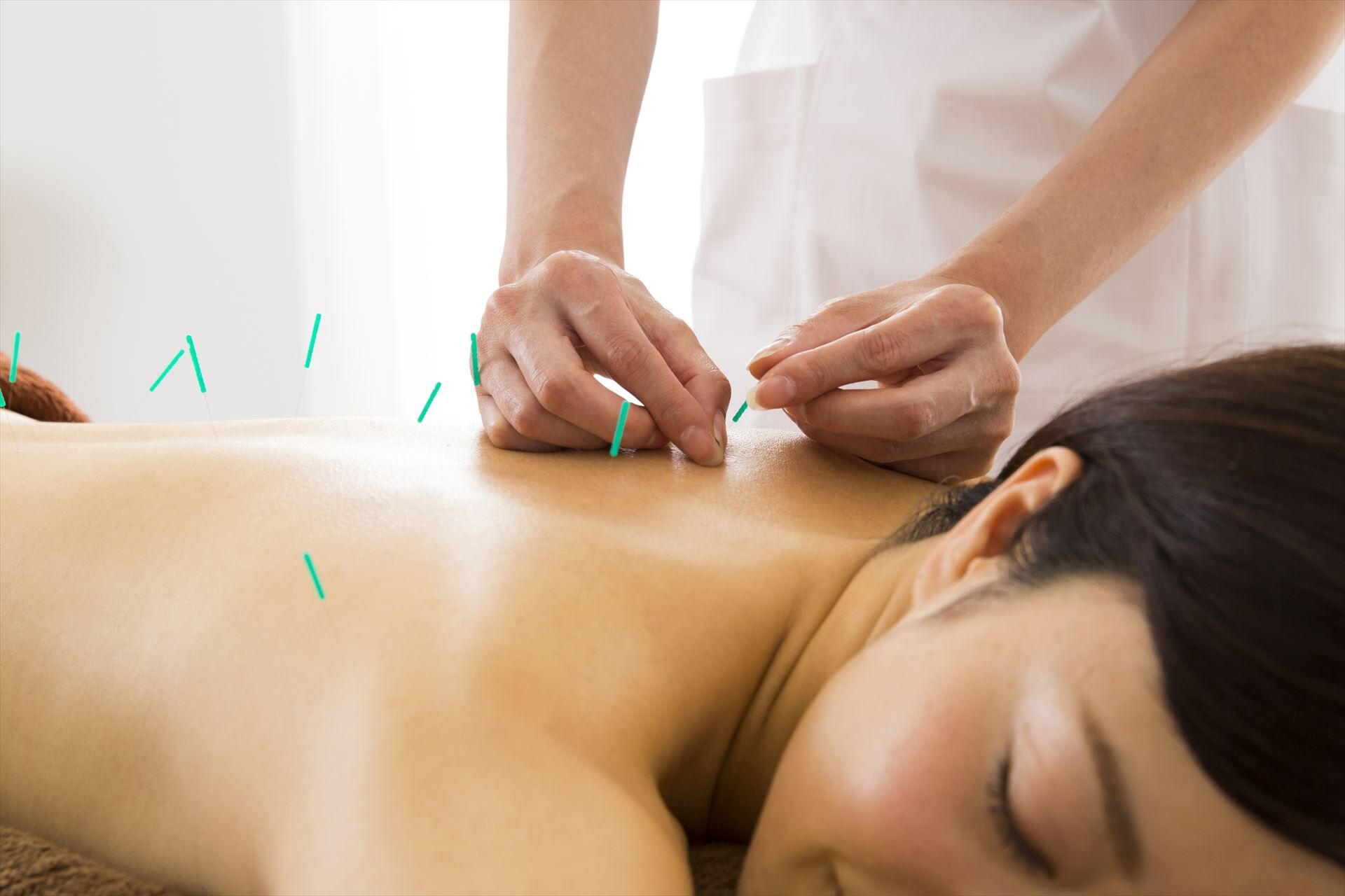 背中前面に鍼を打たれた女性